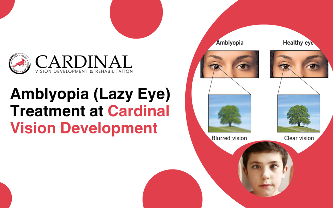 Amblyopia (Lazy Eye) Treatment at Cardinal Vision Development